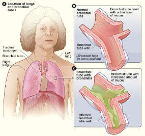 Bronchitis chart